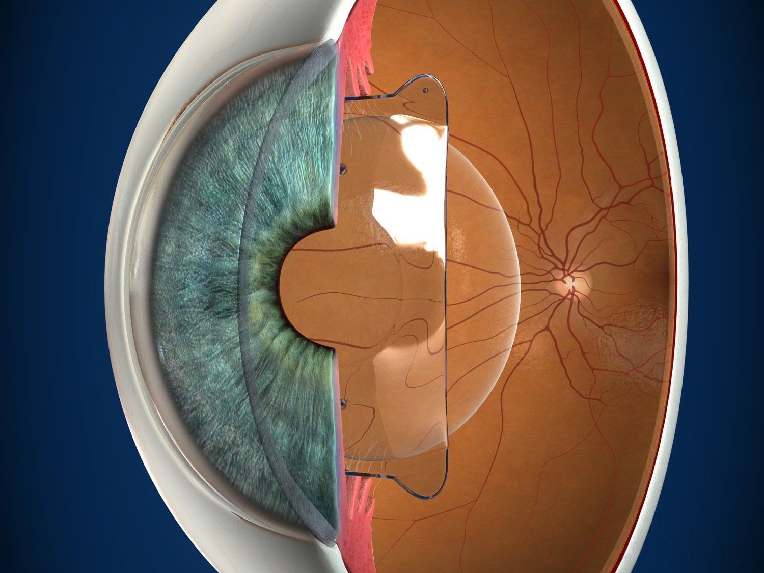 ICL : implant phaque intra-oculaire pour les fortes myopies hors limites du laser
