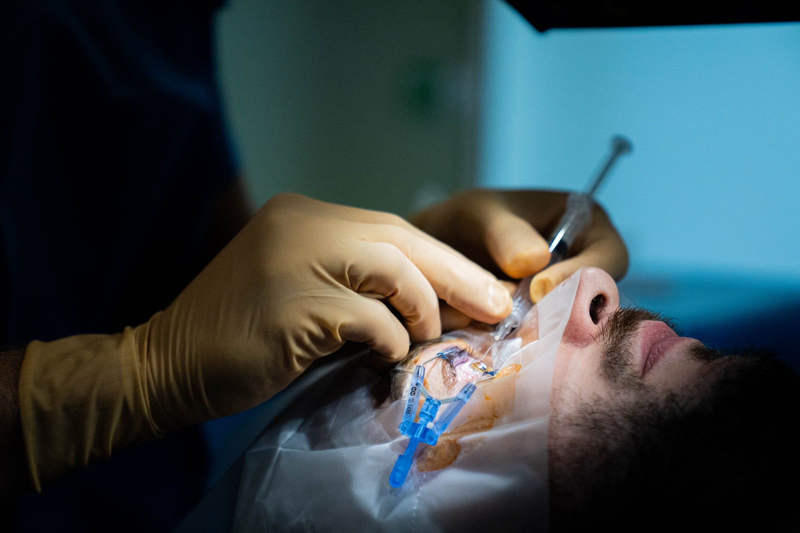 LASIK : laser excimer pour la correction de la myopie, l'hypermétropie et l'astigmatisme