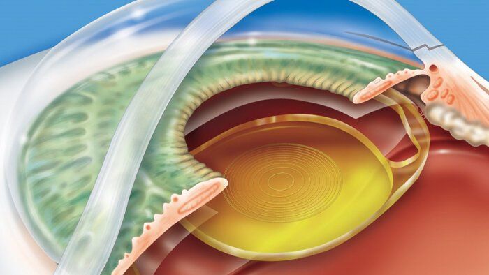 PreLex : remplacement du cristallin par implant multifocal pour la presbytie